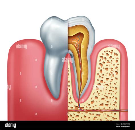 Illustrazione di un dente con canale radicolare infiammato