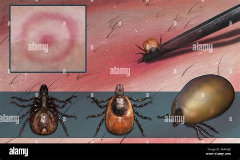 Illustrazione che mostra un morso alto