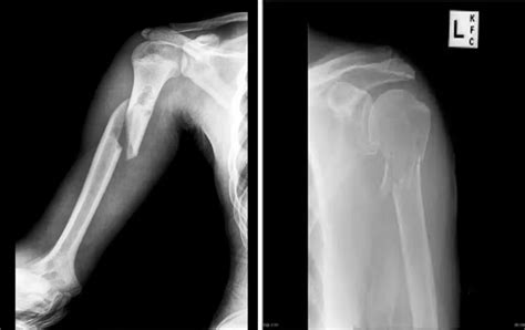 Radiografia di una frattura dell'omero