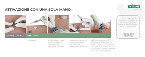 Schema illustrativo della tecnica di inserimento della cannula per ipodermoclisi