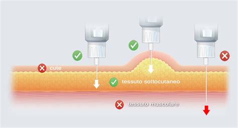 risonanza visiva tra iniezione sottocutanea e sicurezza aghi