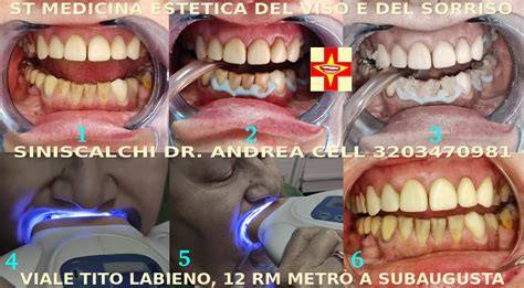 schemi di funzionamento dello sbiancamento dentale