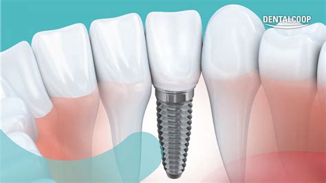Illustrazione schematica di un dente con corona e impianto