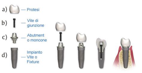 Schema comparativo tra impianto dentale e corona dentale