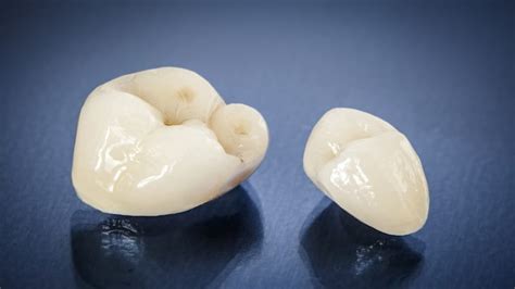 Dettaglio di una corona dentale in ceramica che imita perfettamente un dente naturale